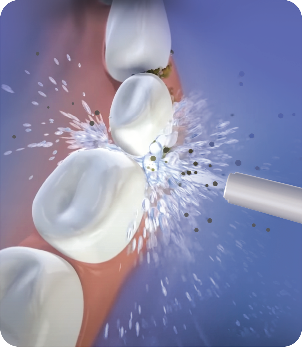 OC150 LITE Smart Water Flosser